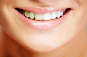 teeth-whitening-results_3.jpg